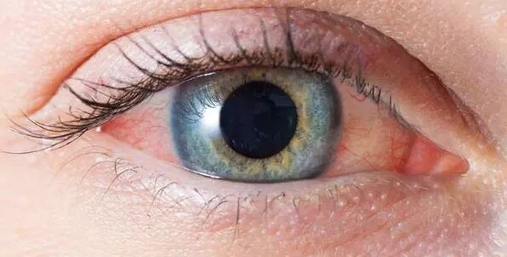 Göz Tansiyonu (Glokom) Nedir? Belirtileri ve Tedavileri Nelerdir?