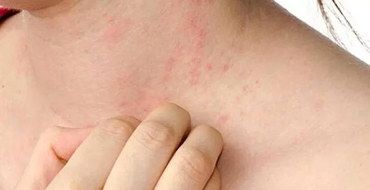 Uyuz Nedir Nasıl Geçer?