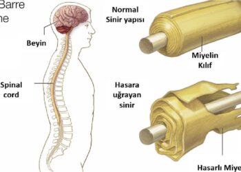 Guillain barre sendromu