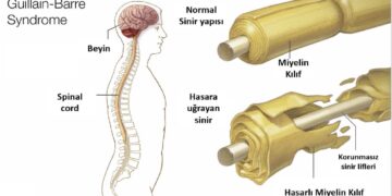 Guillain barre sendromu