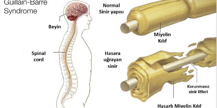 Guillain barre sendromu
