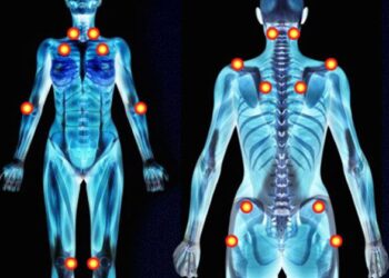 Fibromiyalji Nedir? Fibromiyalji ağrıları nerelerde olur?