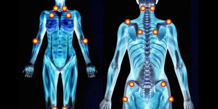 Fibromiyalji Nedir? Fibromiyalji ağrıları nerelerde olur?