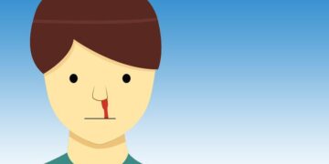 Burun Kanaması Neden Olur? Tedavisi Nedir?