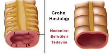 Crohn hastalığı Nedir? Tedavisi Nasıl Yapılır?