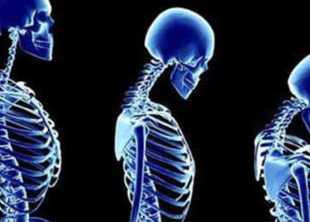 Kemik Erimesi Belirtileri – Kemik Erimesine Ne İyi Gelir?