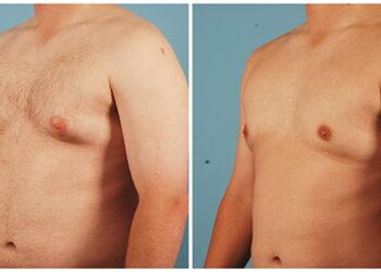 Jinekomasti Nedir, Belirtileri Nelerdir? Tedavisi Nasıl Yapılır?