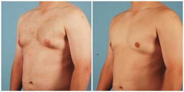 Jinekomasti Nedir, Belirtileri Nelerdir? Tedavisi Nasıl Yapılır?